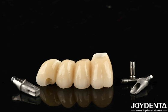 Coronilla y puente de implantes personalizables en porcelana de precisión para una función perfecta