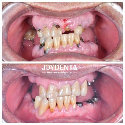 Resistente al desgaste y a la deformación Coronas dentales de zirconia Duraderas y adecuadas para restauraciones posteriores y anteriores