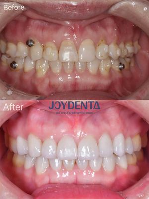 Restauración oral con carillas de porcelana