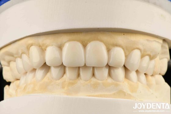 Encerado Diagnóstico Estético Biomimético Dental de Carillas