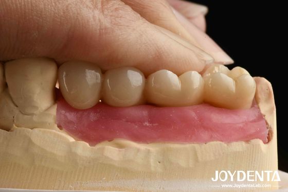 Procesamiento de ultra precisión Implantes de zirconio con diseño asistido por IA y perforación gingival biónica para corona integrada de zirconio