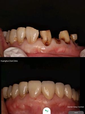 Coronas de Zirconia Premium para los laboratorios dentales globales.
