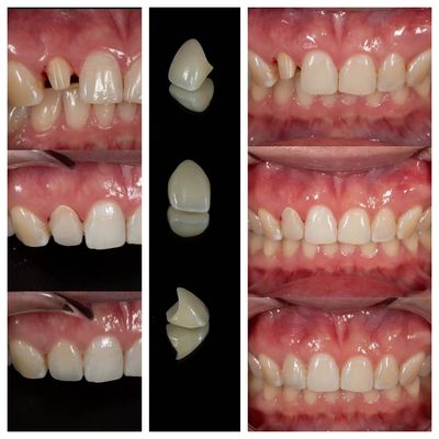 Laboratorio de Fabricación de Coronas Dentales de Zirconia | Outsourcing de Coronas de Precisión - Joydentalab