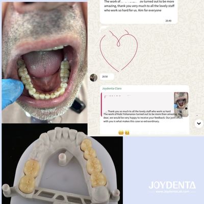 Dentaduras de zirconia que imitan los dientes naturales