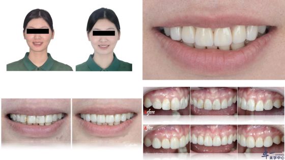 Productos populares de Joydentalab: Carillas estéticas simuladas