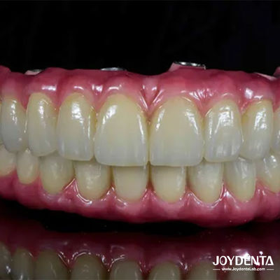 Puente Híbrido de Titanio Dental de Malong ligero Confortable para la restauración dental