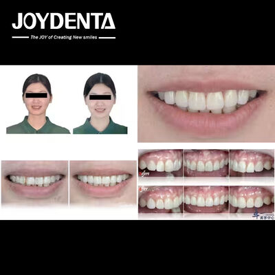 Productos populares de Joydentalab: Carillas estéticas simuladas