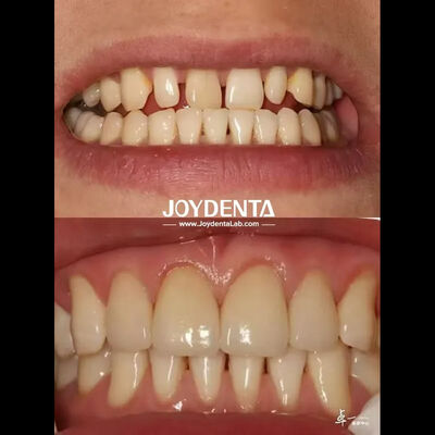 Carillas dentales duraderas sin decoloración perfectas para necesidades de abastecimiento B2B y más