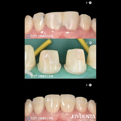 Coronas dentales de zirconia de ajuste perfecto con sistemas CAD CAM