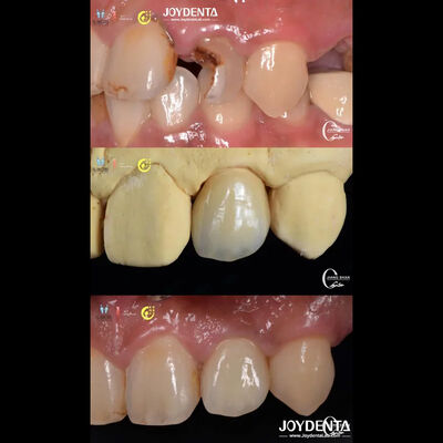 Apariencia de los dientes realista Puentes de zirconia Restauración dental Resistente al desgaste