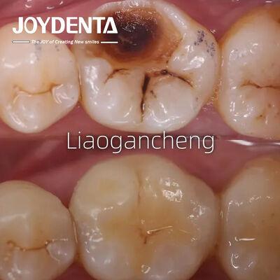 Incremento dental de porcelana restaurador para adultos y niños Rendimiento excepcional