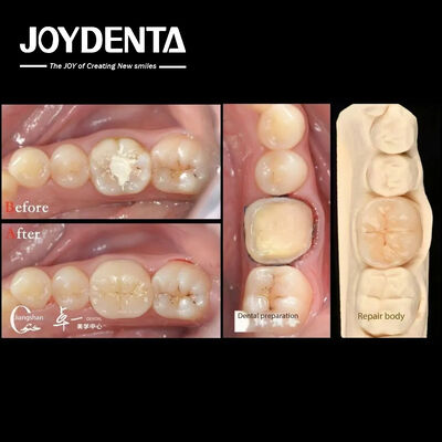 Biocompatibilidad y alta compatibilidad con la restauración de dientes naturales