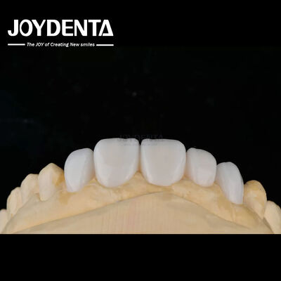 Materiales de porcelana de personalización carillas de dientes Emax para una unión de alta estética