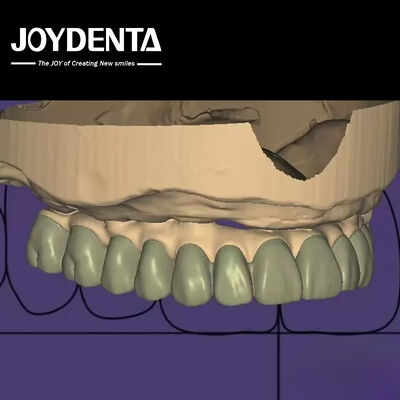 Diseño individualizado de diagnóstico digital de laboratorio de software de cera integración sin fisuras