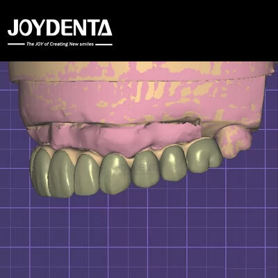 Seguridad de datos compatible con HIPAA Modelo 3D de cera digital para modificaciones dentales